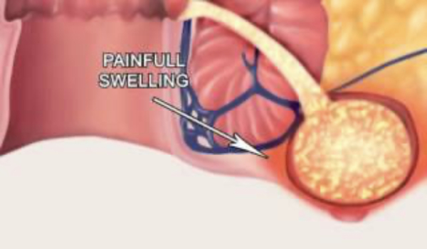 Cirugía del absceso anorectal